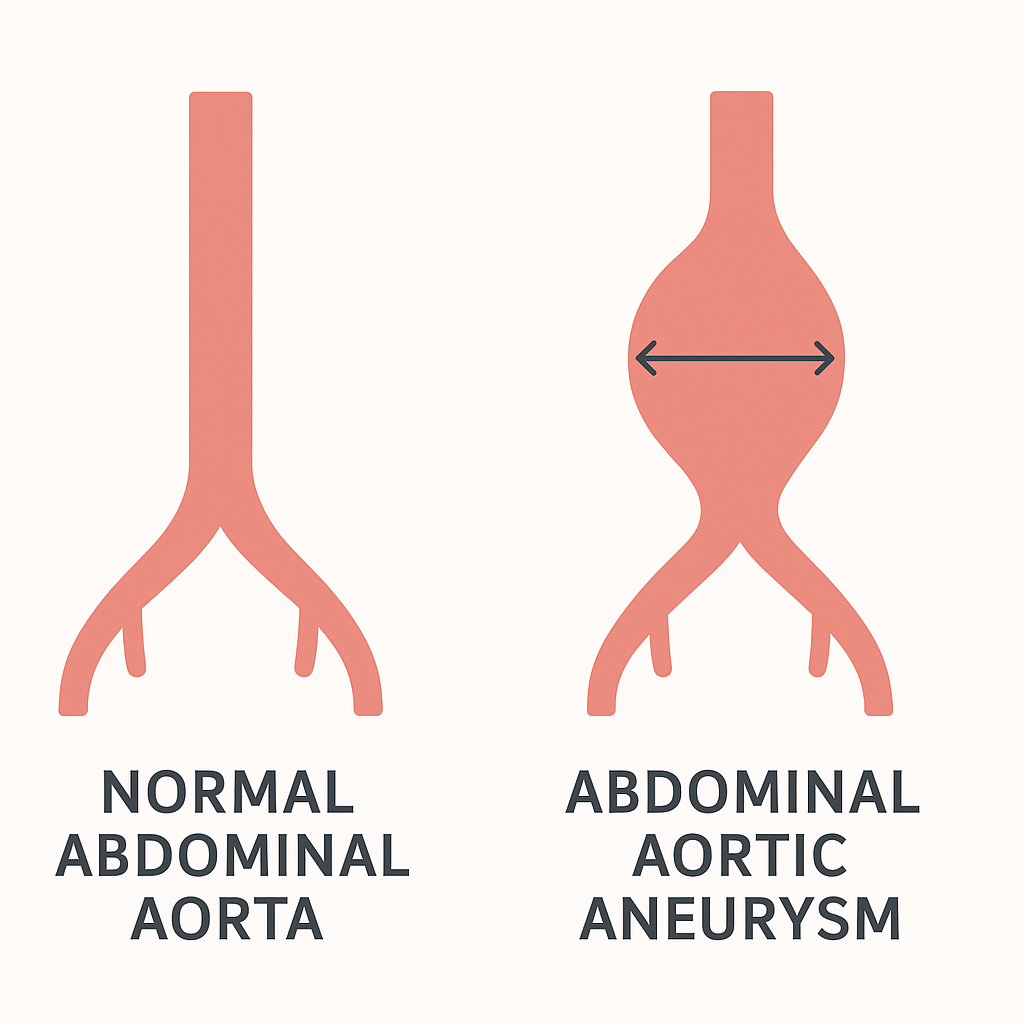 Side-by-side diagram comparing a normal abdominal aorta with an aneurysmal one showing a balloon-like bulge.