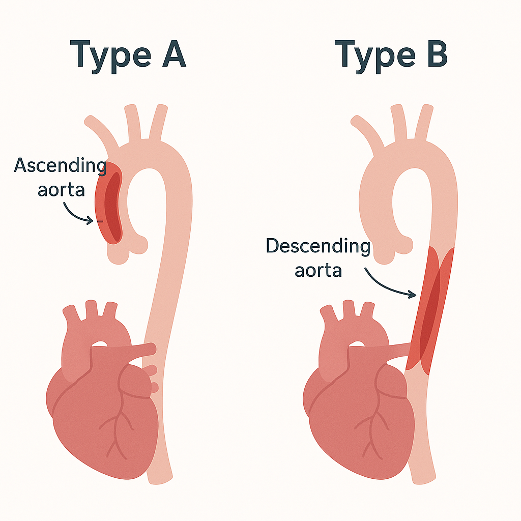 Diagram comparing type A aortic dissection involving the ascending aorta and type B involving only the descending aorta.