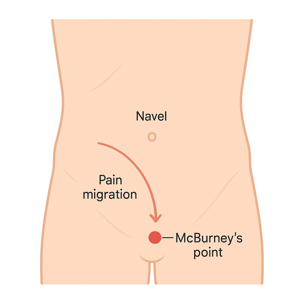 Diagram of the abdomen marking McBurney's point in the lower right and an arrow showing pain migrating from the navel.