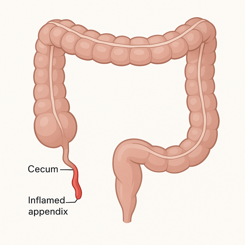 Diagram of the large intestine with an inflamed appendix in the lower right abdomen. The appendix is a small finger-shaped pouch hanging off the start of the large intestine in the lower right belly. It is blocked, swollen and inflamed.