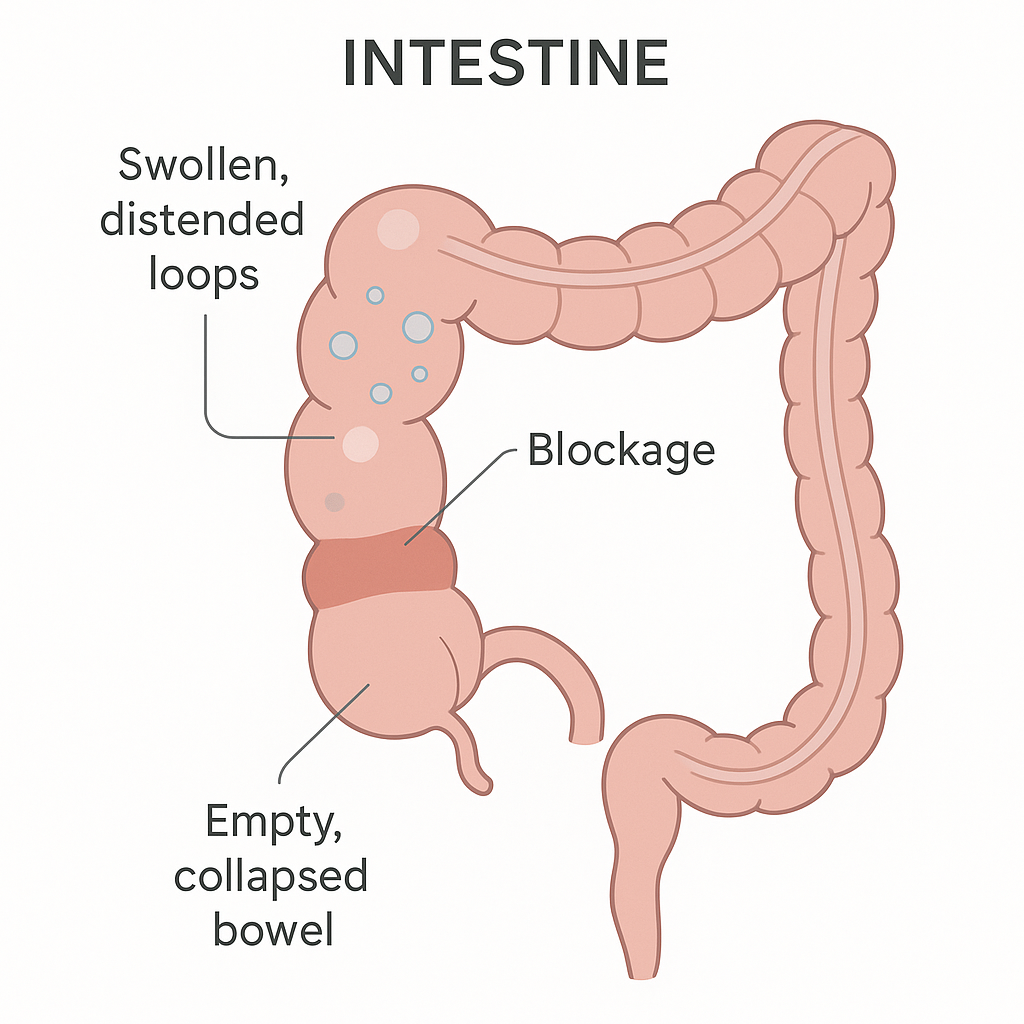 Diagram of intestine blocked at one point with swollen loops above it. A length of intestine is blocked at one point. The loops before the blockage are stretched and swollen with trapped food, fluid and gas, while the bowel beyond it is empty and flat.