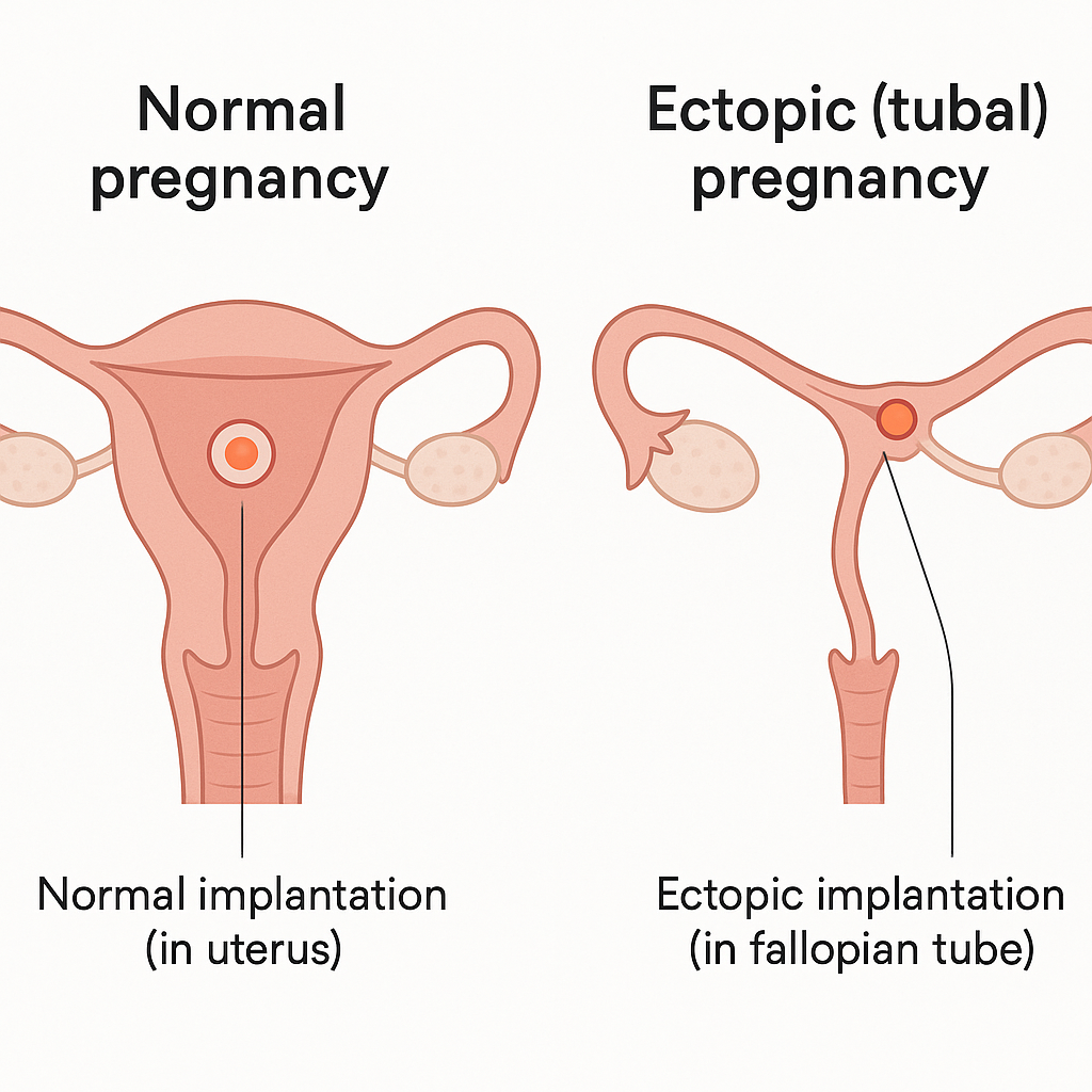 Diagram comparing a normal pregnancy implanted in the uterus with an ectopic pregnancy implanted in the fallopian tube.
