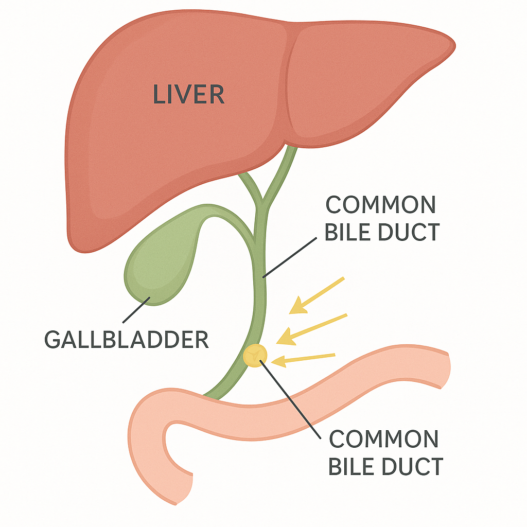Diagram of a gallstone blocking the common bile duct, causing bile to back up toward the liver.