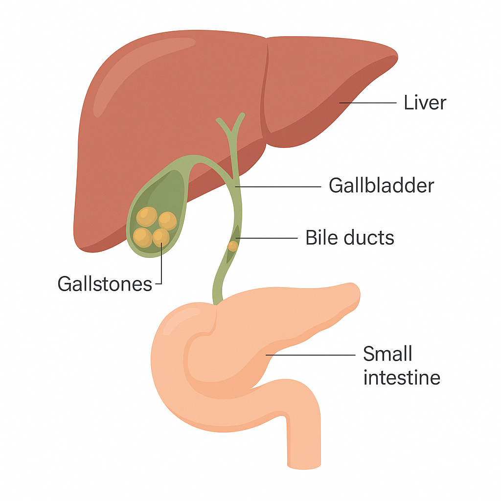 Diagram of the liver, gallbladder and bile ducts with stones blocking the duct. The gallbladder sits under the liver and stores bile. Stones have formed inside it; one has slipped into the duct that drains toward the intestine and is blocking the exit.