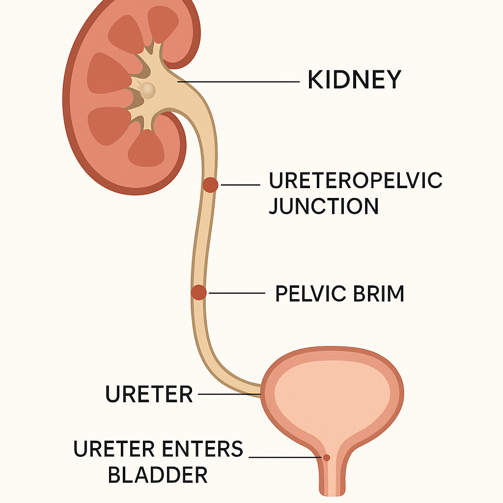 Diagram of the urinary tract marking the three narrow points where kidney stones commonly get stuck: the ureteropelvic junction, the pelvic brim, and the entry into the bladder.